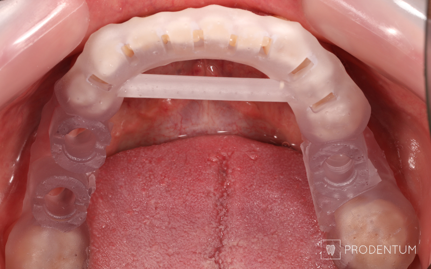 Dantų implantacijos gidas Dantų implantacijos gidas