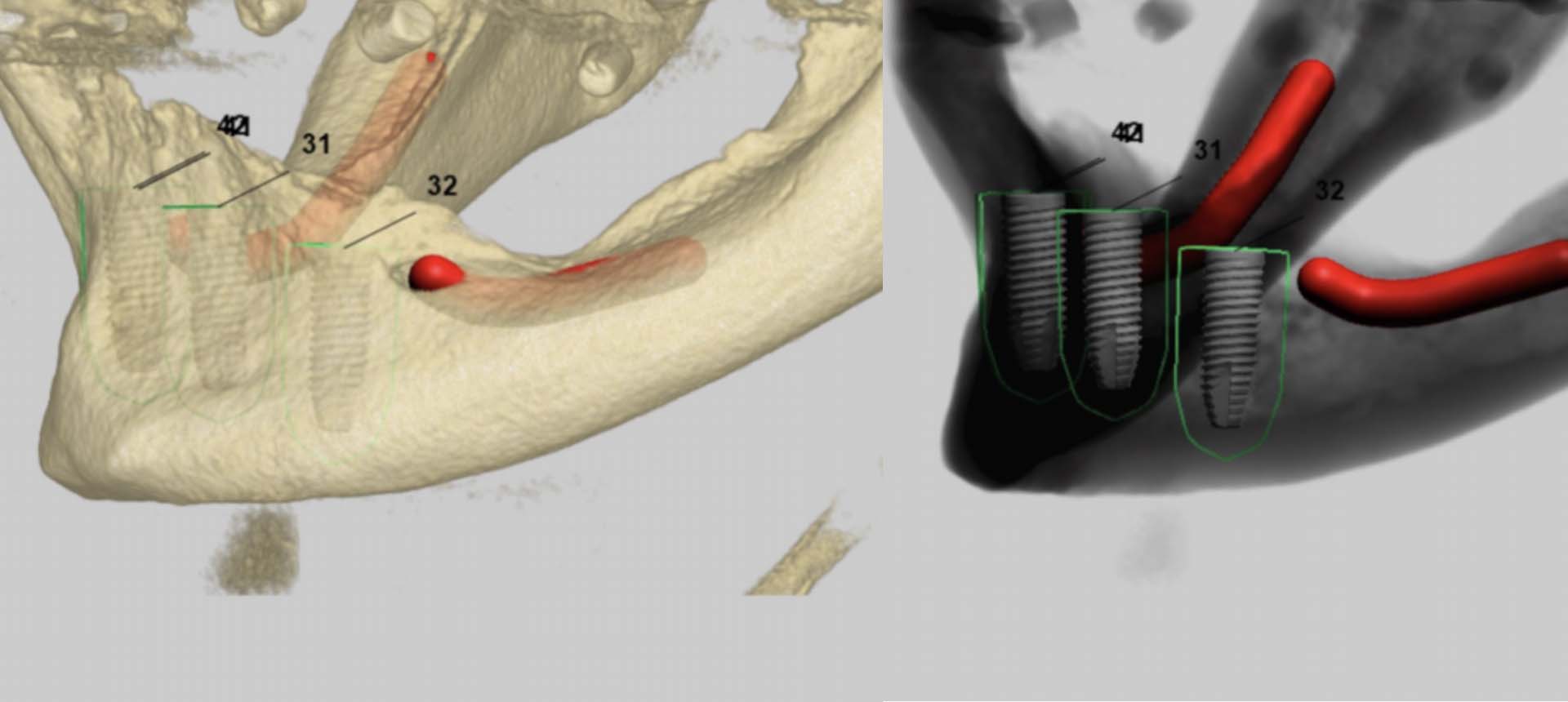 Alveolar augmentation using bone blocks/bone substitutes