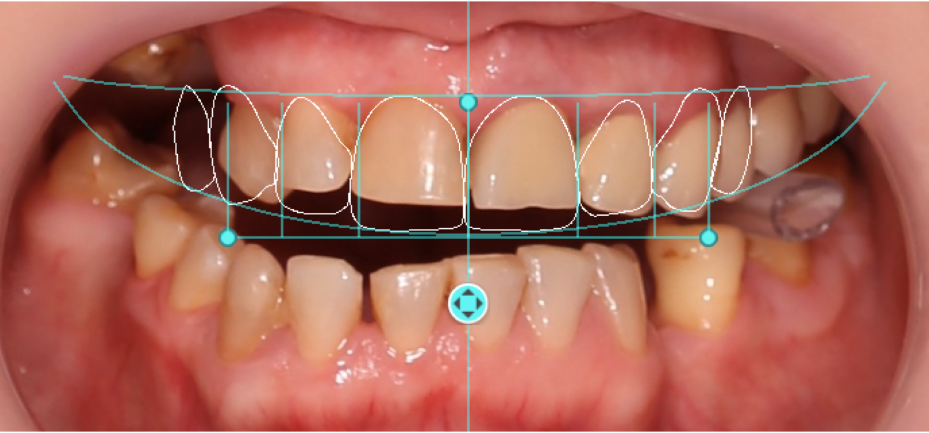 Digital smile design