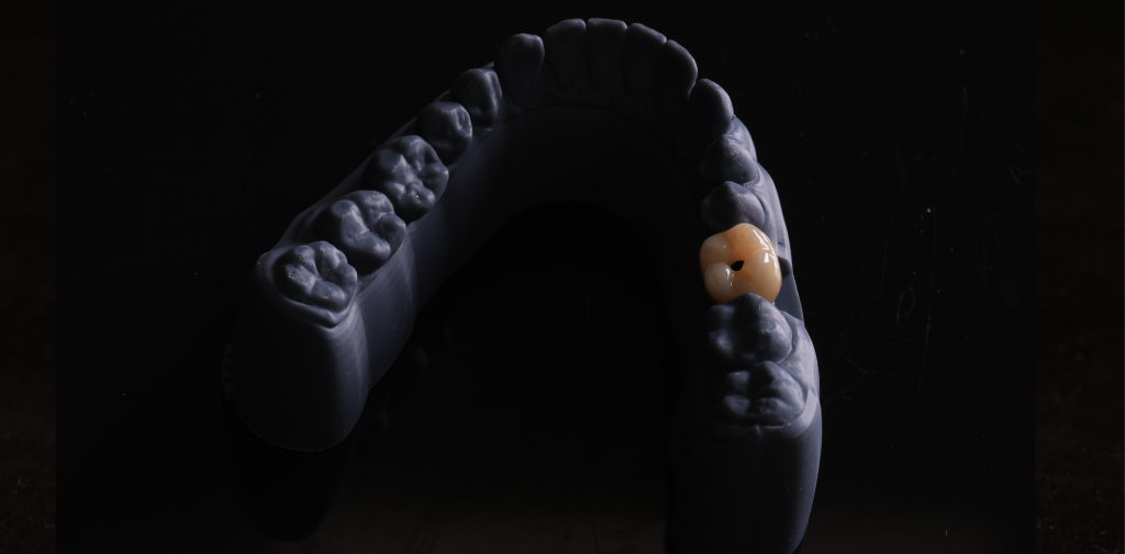 Tooth prosthetics