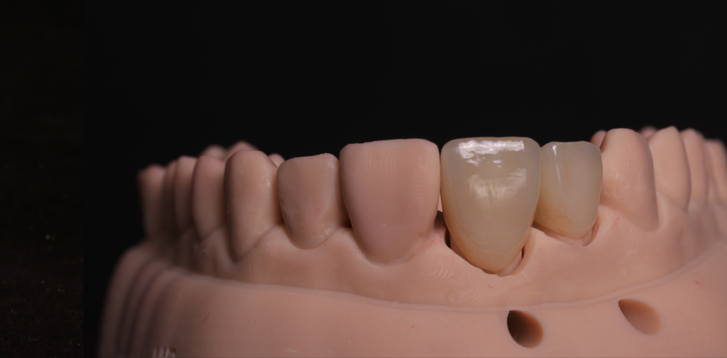 Tooth prosthetics