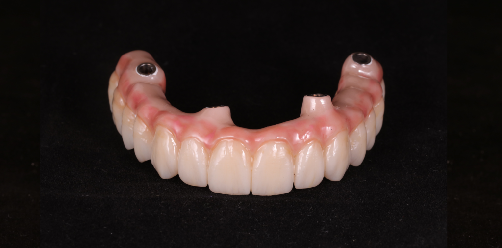 Tooth prosthetics