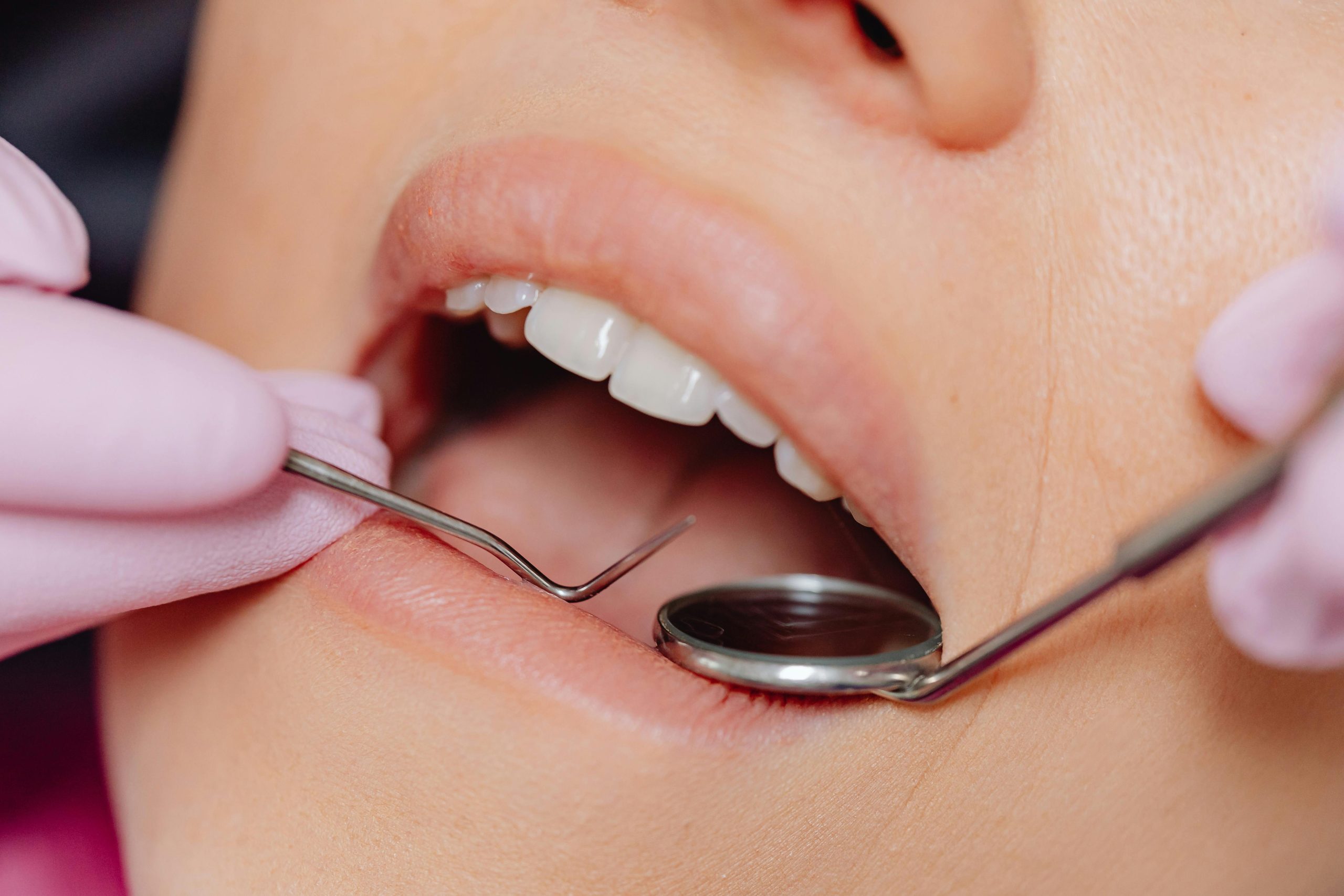 Gingivitas